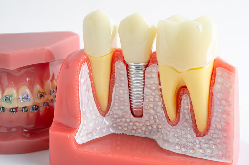 Dentist holding a dental implants model with blue gloves on in a dental office